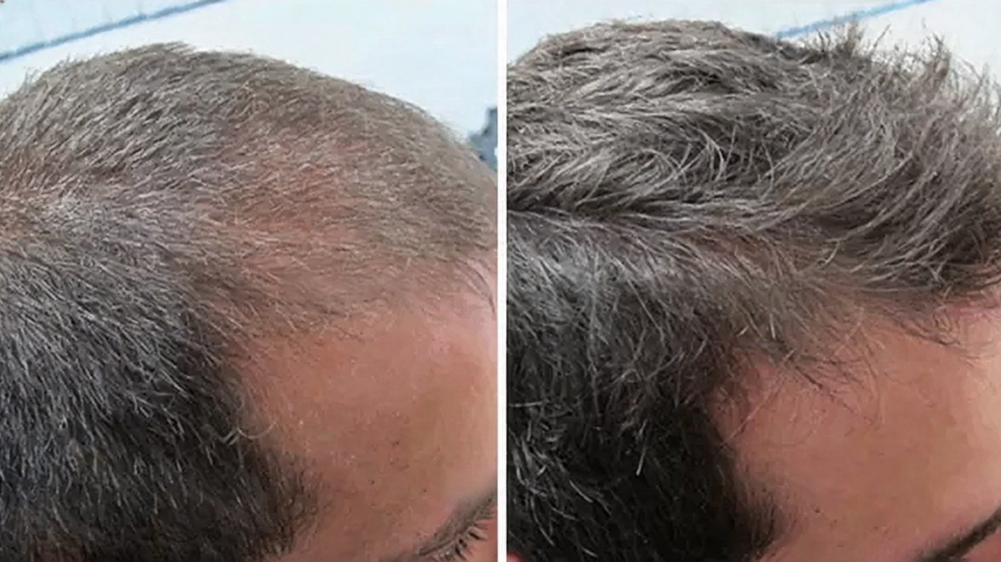 Before and after progress on a sustained daily protocol, months 0 to 12
