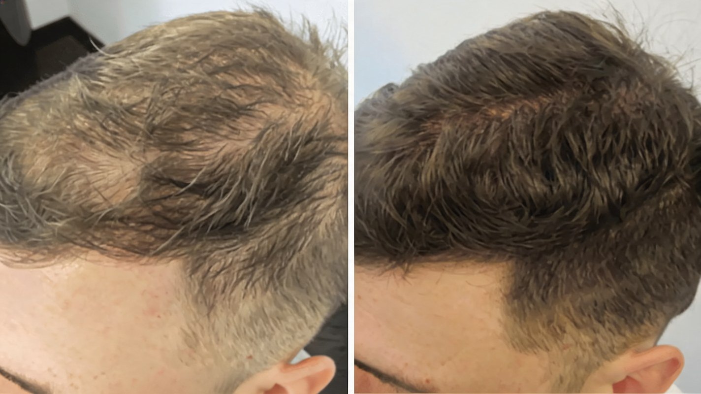 Before and after progress on oral finasteride and minoxidil, months 0 to 10