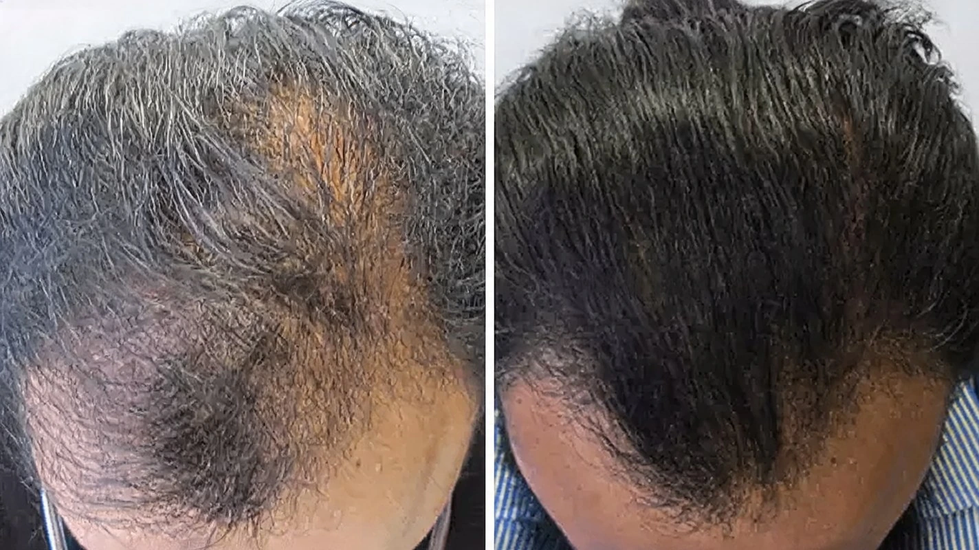 Before and after combination-therapy progress, months 0 to 8